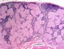 Migraine a Common Comorbidity in Individuals With Sarcoidosis Migraine a Common Comorbidity in Individuals With Sarcoidosis
