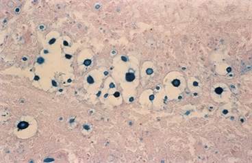 Fungal Infections of the CNS: Diagnostic and Treatment Approaches Fungal Infections of the CNS: Diagnostic and Treatment Approaches