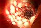IBD Associated With Increased Incidence of Parkinson Disease IBD Associated With Increased Incidence of Parkinson Disease