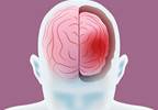 Nonlanguage Mathematical, Visuospatial Learning Disabilities Likely in Focal Neurodegenerative Syndromes Nonlanguage Mathematical, Visuospatial Learning Disabilities Likely in Focal Neurodegenerative Syndromes