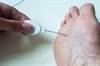 Normalized HbA1c Levels Facilitate Improved Neuropathy Outcomes in T2D Normalized HbA1c Levels Facilitate Improved Neuropathy Outcomes in T2D