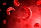 Sickle Cell Trait Does Not Reliably Predict Ischemic Stroke in African Americans Sickle Cell Trait Does Not Reliably Predict Ischemic Stroke in African Americans