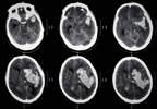 Prediction Algorithm Stratifies ICH Patients at Risk for Hematoma Expansion Prediction Algorithm Stratifies ICH Patients at Risk for Hematoma Expansion
