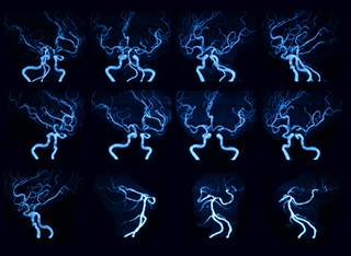 The combination of clopidogrel and aspirin is associated with reduced risk of major ischemic events but increased risk of major hemorrhage among patients with minor ischemic stroke. The combination of clopidogrel and aspirin is associated with reduced risk of major ischemic events but increased risk of major hemorrhage among patients with minor ischemic stroke.