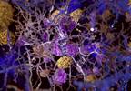 Amyloid Positivity Increases Risk for Cognitive Impairment in Dementia-Free Patients Amyloid Positivity Increases Risk for Cognitive Impairment in Dementia-Free Patients