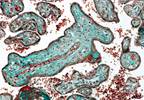 Valproic Acid-Related Adverse Fetal Outcomes May Be Linked to Placental Effects Valproic Acid-Related Adverse Fetal Outcomes May Be Linked to Placental Effects
