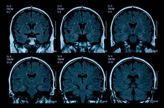 People with multiple sclerosis who initiated treatment with fingolimod after 2 previous iDMTs showed improved outcomes, such as a smaller degree of brain volume loss. People with multiple sclerosis who initiated treatment with fingolimod after 2 previous iDMTs showed improved outcomes, such as a smaller degree of brain volume loss.