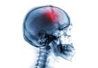 Cardiovascular Risks Persist Following Transient Ischemic Attack or Minor Stroke Cardiovascular Risks Persist Following Transient Ischemic Attack or Minor Stroke