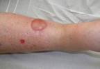 Link Between Oral Diabetes Medications and Bullous Pemphigoid Link Between Oral Diabetes Medications and Bullous Pemphigoid