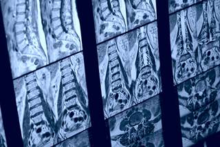 Spinal cord volume loss may be a predictor of clinical outcomes in primary progressive multiple sclerosis. Spinal cord volume loss may be a predictor of clinical outcomes in primary progressive multiple sclerosis.