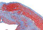 Cardiac Pathology in SUDEP Compared With Sudden Arrhythmic or Traumatic Deaths Cardiac Pathology in SUDEP Compared With Sudden Arrhythmic or Traumatic Deaths