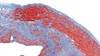 Cardiac Pathology in SUDEP Compared With Sudden Arrhythmic or Traumatic Deaths Cardiac Pathology in SUDEP Compared With Sudden Arrhythmic or Traumatic Deaths