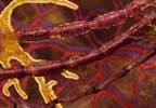 Electrophysiologic Features Specific to Transthyretin Familial Amyloid Polyneuropathies Electrophysiologic Features Specific to Transthyretin Familial Amyloid Polyneuropathies