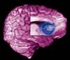Tumor-Related Headache: Path to Diagnosis, Treatment Isn't Always Obvious Tumor-Related Headache: Path to Diagnosis, Treatment Isn't Always Obvious