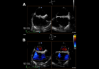 Patent Foramen Ovale Closure for Stroke Prevention: Key Principles for Clinical Practice Patent Foramen Ovale Closure for Stroke Prevention: Key Principles for Clinical Practice