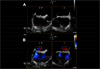 Patent Foramen Ovale Closure for Stroke Prevention: Key Principles for Clinical Practice Patent Foramen Ovale Closure for Stroke Prevention: Key Principles for Clinical Practice