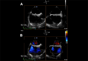 Patent Foramen Ovale Closure for Stroke Prevention: Key Principles for Clinical Practice Patent Foramen Ovale Closure for Stroke Prevention: Key Principles for Clinical Practice