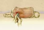 Identifying Intracranial Hypertension in Children: Added Challenges Identifying Intracranial Hypertension in Children: Added Challenges
