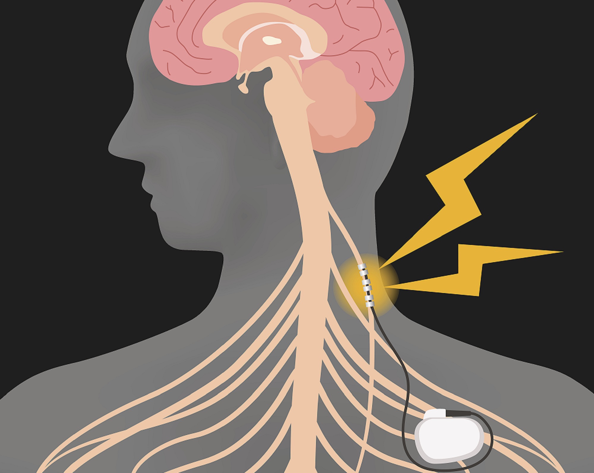Vagus Nerve Stimulation in Pediatric Epilepsy: Weighing the Risks and