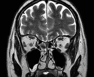 The use of MRI is recommended to improve to identify patients presenting with optic neuritis who have an increased high risk for MS. The use of MRI is recommended to improve to identify patients presenting with optic neuritis who have an increased high risk for MS.
