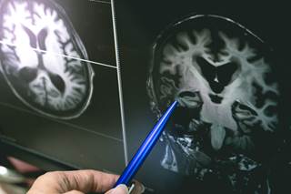 Cerebral microbleeds occurred more often in patients with Parkinson disease and dementia. Cerebral microbleeds occurred more often in patients with Parkinson disease and dementia.