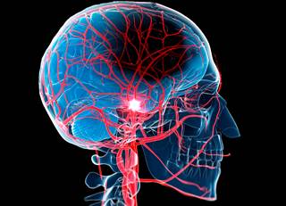 Second study shows patients more likely to have influenza-like illness within 30 days preceding cervical artery dissection. Second study shows patients more likely to have influenza-like illness within 30 days preceding cervical artery dissection.