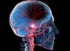 Predicting Poststroke Depression: Biomarkers and Beyond Predicting Poststroke Depression: Biomarkers and Beyond