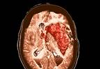 Early Neurological Deterioration in Intracranial Hemorrhage Linked to Worse Outcomes Early Neurological Deterioration in Intracranial Hemorrhage Linked to Worse Outcomes