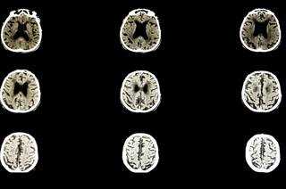In patients with progressive multiple sclerosis, slower progression of brain atrophy was seen with ibudilast versus placebo. In patients with progressive multiple sclerosis, slower progression of brain atrophy was seen with ibudilast versus placebo.