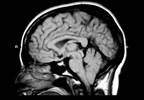 Chiari Malformation: Wading Through the Confusion Chiari Malformation: Wading Through the Confusion