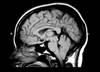 Chiari Malformation: Wading Through the Confusion Chiari Malformation: Wading Through the Confusion