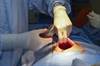 Managing Complications of Intrathecal Baclofen Therapy Managing Complications of Intrathecal Baclofen Therapy