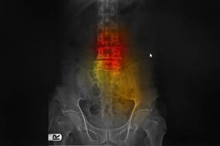 Of the total participants, 79.6% had arthritic changes, 38.8% were diagnosed scoliosis, and 24.1% had spondylolisthesis with instability observed. Of the total participants, 79.6% had arthritic changes, 38.8% were diagnosed scoliosis, and 24.1% had spondylolisthesis with instability observed.