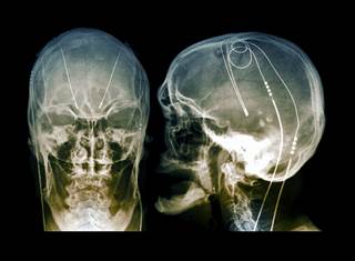 Deep brain stimulation showed long-term benefits in both younger and older patients with Parkinson disease. <i>Credit:ZEPHYR/Science Source</i> Deep brain stimulation showed long-term benefits in both younger and older patients with Parkinson disease. <i>Credit:ZEPHYR/Science Source</i>