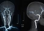Characteristics Linked to Arterial Recanalization Following Alteplase Treatment in Ischemic Stroke Characteristics Linked to Arterial Recanalization Following Alteplase Treatment in Ischemic Stroke