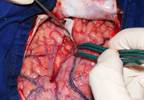 Resective Epilepsy Surgery Reduces Seizures, Improves Social Functioning in Lennox-Gastaut Syndrome Resective Epilepsy Surgery Reduces Seizures, Improves Social Functioning in Lennox-Gastaut Syndrome