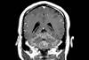 New Diagnostic Criteria for Neurosarcoidosis: What You Need to Know New Diagnostic Criteria for Neurosarcoidosis: What You Need to Know