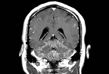 New Diagnostic Criteria for Neurosarcoidosis: What You Need to Know New Diagnostic Criteria for Neurosarcoidosis: What You Need to Know