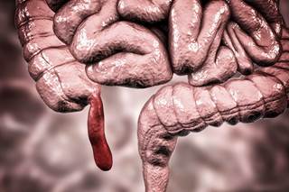The normal human appendix seems to contain pathogenic forms of α-synuclein, which may impact the risk for developing Parkinson disease. The normal human appendix seems to contain pathogenic forms of α-synuclein, which may impact the risk for developing Parkinson disease.