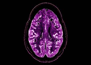 Symptoms of RVCL mimic those of tumefactive multiple sclerosis. <i>Credit:Living Art Enterprises/Science Source</i> Symptoms of RVCL mimic those of tumefactive multiple sclerosis. <i>Credit:Living Art Enterprises/Science Source</i>