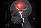 Eslicarbazepine Acetate Well Tolerated, Effective in Post-Stroke Epilepsy Eslicarbazepine Acetate Well Tolerated, Effective in Post-Stroke Epilepsy