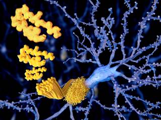 Investigators examined the onset, sequence, and rate of progression of biomarker and clinical measures across the spectrum of Alzheimer disease, using the Dominantly Inherited Alzheimer Network study. Investigators examined the onset, sequence, and rate of progression of biomarker and clinical measures across the spectrum of Alzheimer disease, using the Dominantly Inherited Alzheimer Network study.
