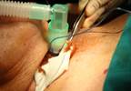Pharyngeal Electrical Stimulation Improves Readiness for Decannulation in Post-Stroke Dysphagia Pharyngeal Electrical Stimulation Improves Readiness for Decannulation in Post-Stroke Dysphagia