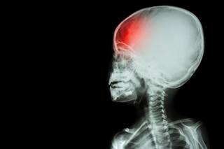 Children with a TBI are more likely to have additional neurologic and physiologic comorbidities. Children with a TBI are more likely to have additional neurologic and physiologic comorbidities.