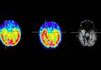 SISCOM Hyperperfusion Identifies Epilepsy Lateralization SISCOM Hyperperfusion Identifies Epilepsy Lateralization