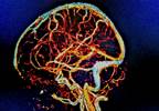 NIHSS May Misjudge Infratentorial Lesions in Thrombolysis-Eligible Stroke NIHSS May Misjudge Infratentorial Lesions in Thrombolysis-Eligible Stroke