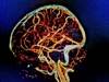 NIHSS May Misjudge Infratentorial Lesions in Thrombolysis-Eligible Stroke NIHSS May Misjudge Infratentorial Lesions in Thrombolysis-Eligible Stroke
