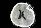TBI Increases Dementia Risk in Middle-Age and Elderly Patients With T1D TBI Increases Dementia Risk in Middle-Age and Elderly Patients With T1D