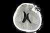 TBI Increases Dementia Risk in Middle-Age and Elderly Patients With T1D TBI Increases Dementia Risk in Middle-Age and Elderly Patients With T1D