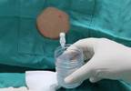 Neurofilament Light Biomarkers Identify Alzheimer Disease Risk in Down Syndrome Neurofilament Light Biomarkers Identify Alzheimer Disease Risk in Down Syndrome